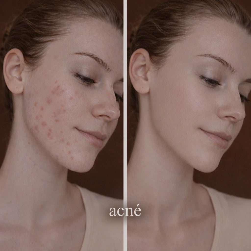 Avant après traitement acné avec appareil haute fréquence Cerafine Paris, réduction des boutons et imperfections de la peau